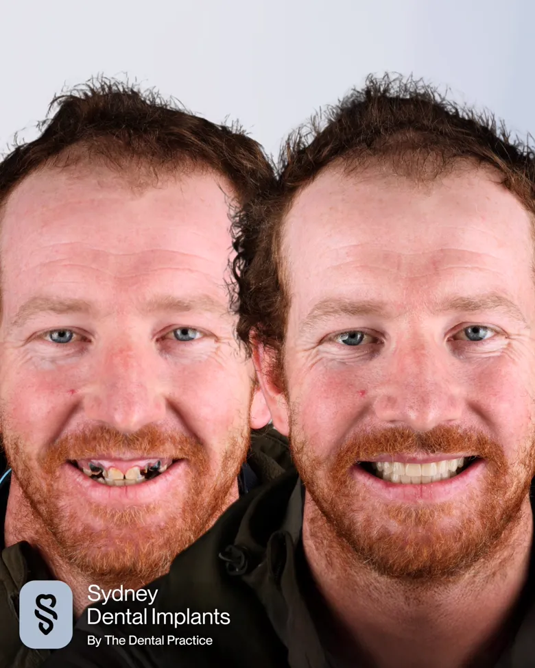 A patient before and after implant treatment