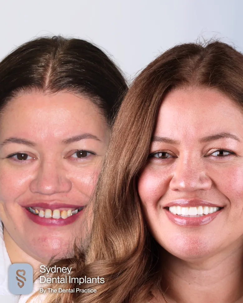 A patient before and after implant treatment