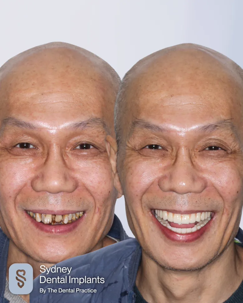 A patient before and after implant treatment