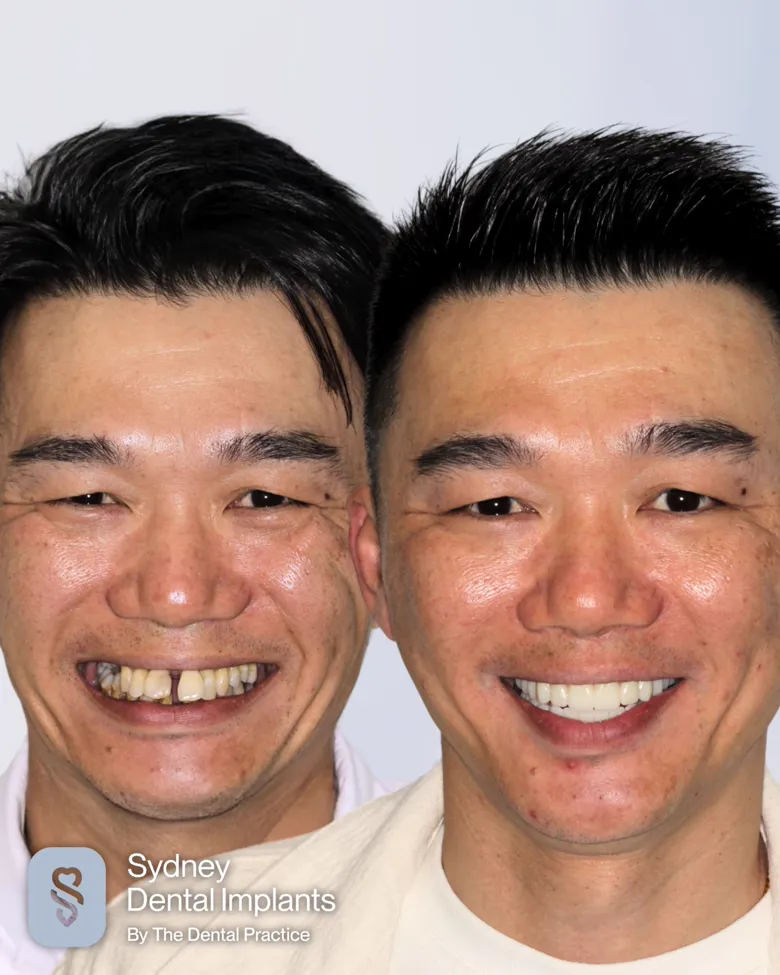 A patient before and after implant treatment