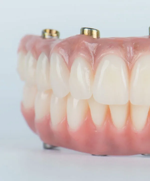 A full arch of fixed teeth supported on implants