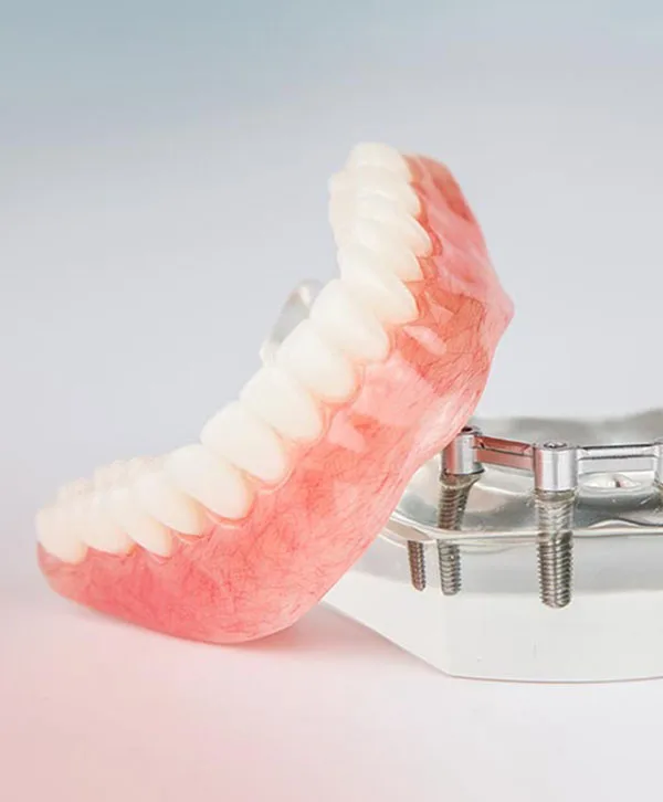 An implant-supported denture